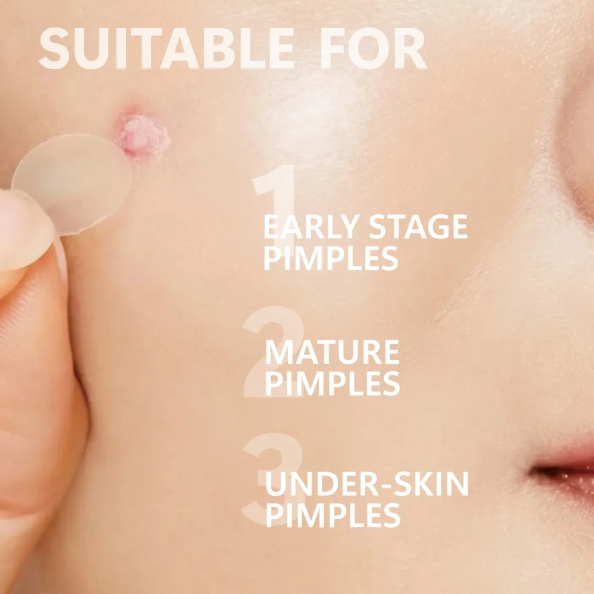 Hydrocolloid Micro-Dart Acne Patches – Clear Skin While You Sleep