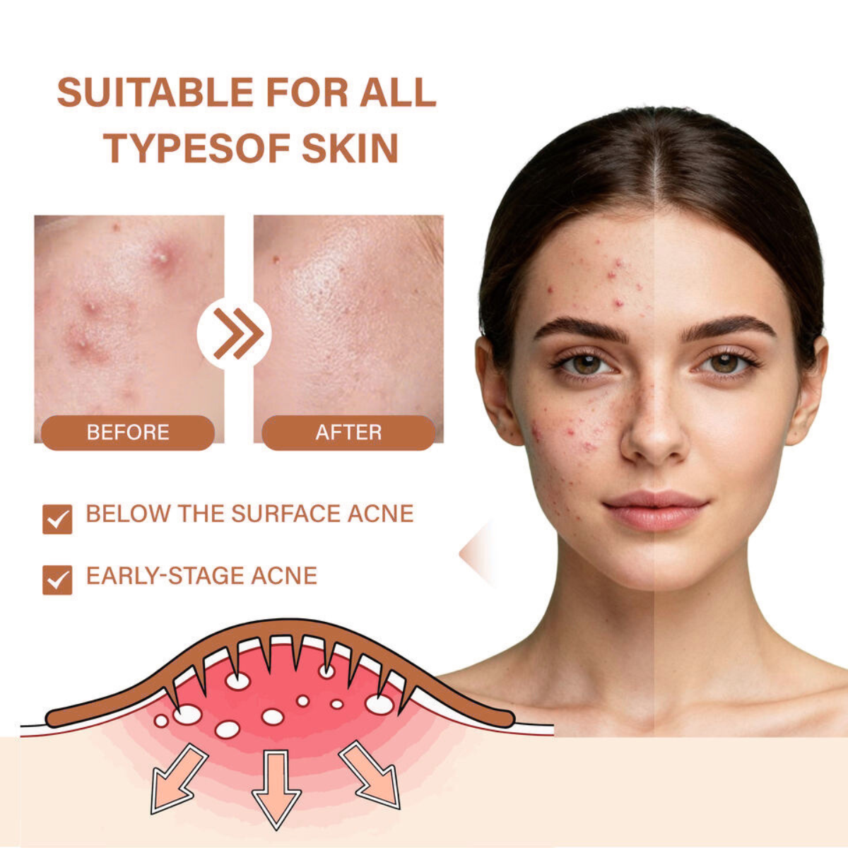 Hydrocolloid Micro-Dart Acne Patches – Clear Skin While You Sleep